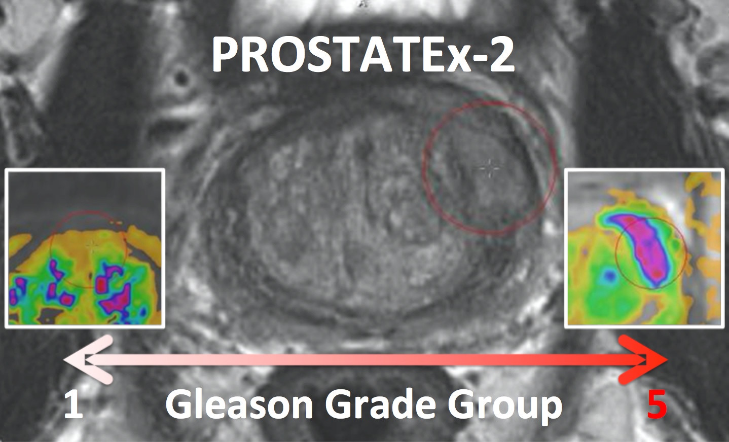 PROSTATEx-2 featured image